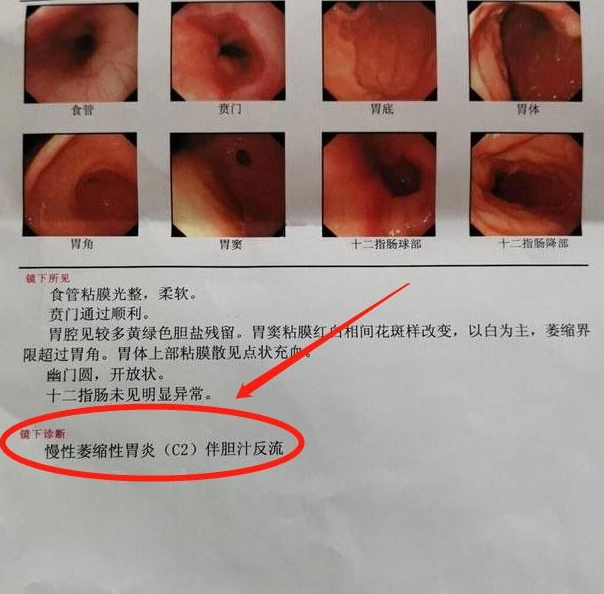 “疫情地区可以买胃药吗	” 疫情期间买胃药会被隔离吗？-第2张图片